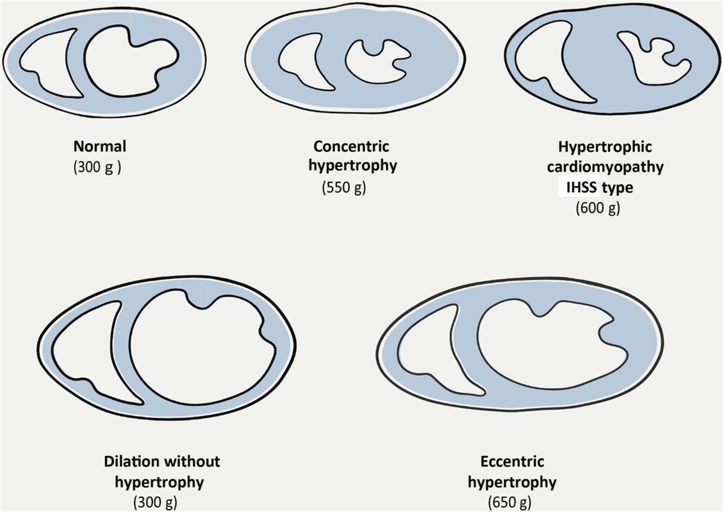 Figure 1.1, Patterns of cardiomegaly.