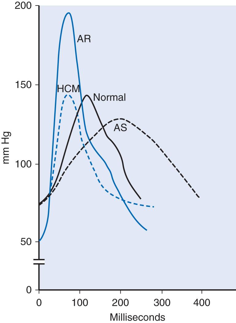 Fig. 1.1, The carotid pulsation. The waveform of the carotid pulse is characterized by the rate of rise of the carotid upstroke. In aortic regurgitation (AR) , the upstroke is rapid and followed by abrupt diastolic “collapse.” In hypertrophic cardiomyopathy (HCM) , the upstroke is also rapid and the pulse has a jerky character. In aortic stenosis (AS) , the upstroke is slow with a plateau.