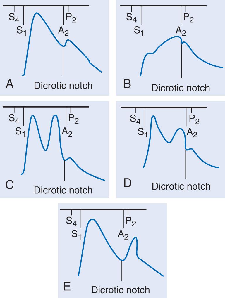 Fig. 1.2, Carotid pulse waveforms and heart sounds. A, Normal. B, Aortic stenosis: anacrotic pulse with slow upstroke and peak near S 2 . C, Severe aortic regurgitation: bifid pulse with two systolic peaks. D, Hypertrophic obstructive cardiomyopathy: bifid pulse with two systolic peaks. The second peak (tidal or reflected wave) is of lower amplitude than the initial percussion wave. E, Bifid pulse with systolic and diastolic peaks as may occur with sepsis or intra-aortic balloon counterpulsation. A 2 , Aortic component of S 2 ; P 2 , pulmonic component of S 2 .