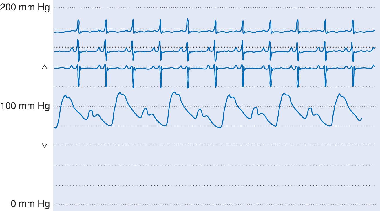 Fig. 1.3, Pulsus alternans in a patient with severe left ventricular systolic dysfunction. The systolic pressure varies from beat to beat, independent of the respiratory cycle. The rhythm is sinus throughout.