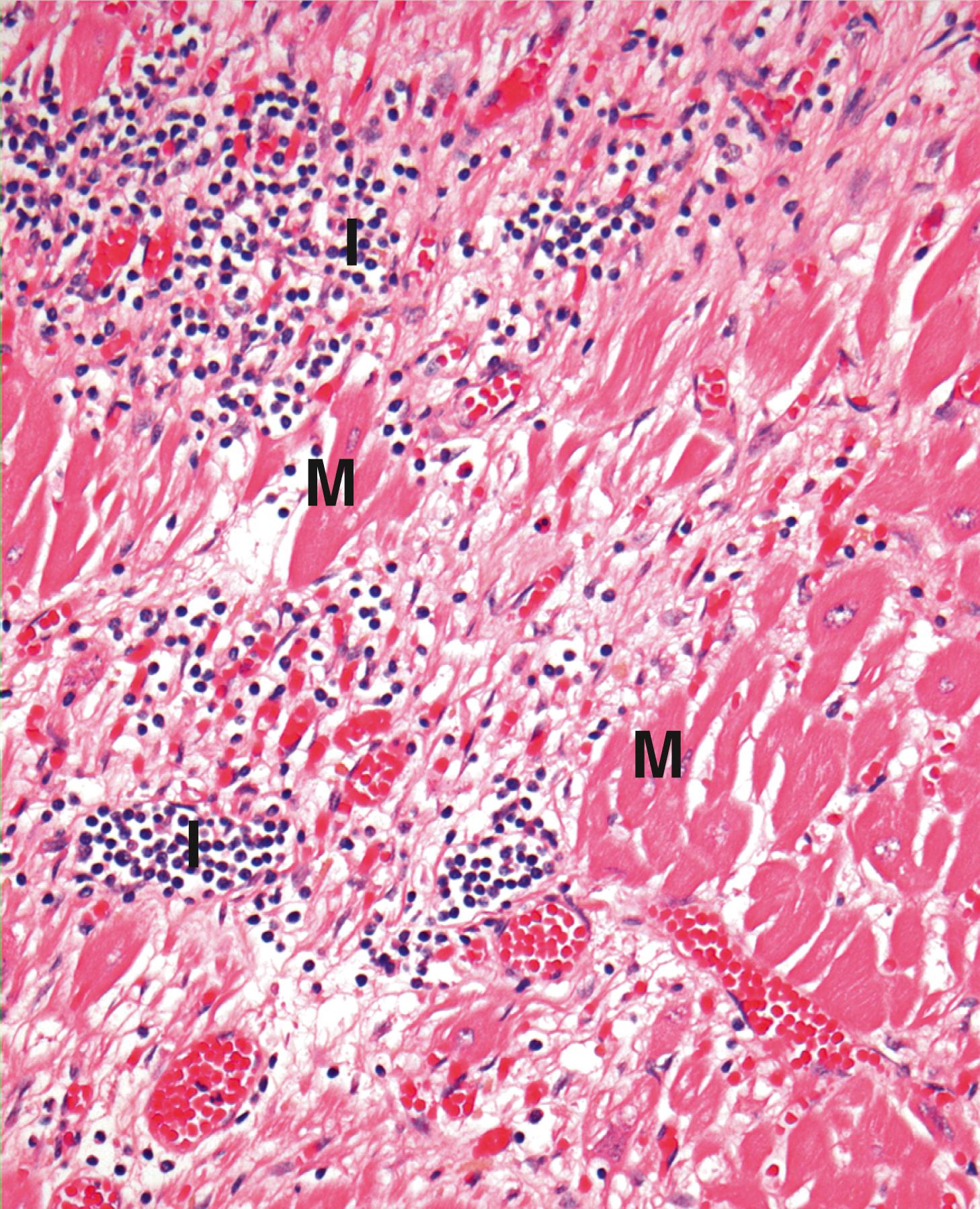 Fig. 11.14, Viral myocarditis (HP).