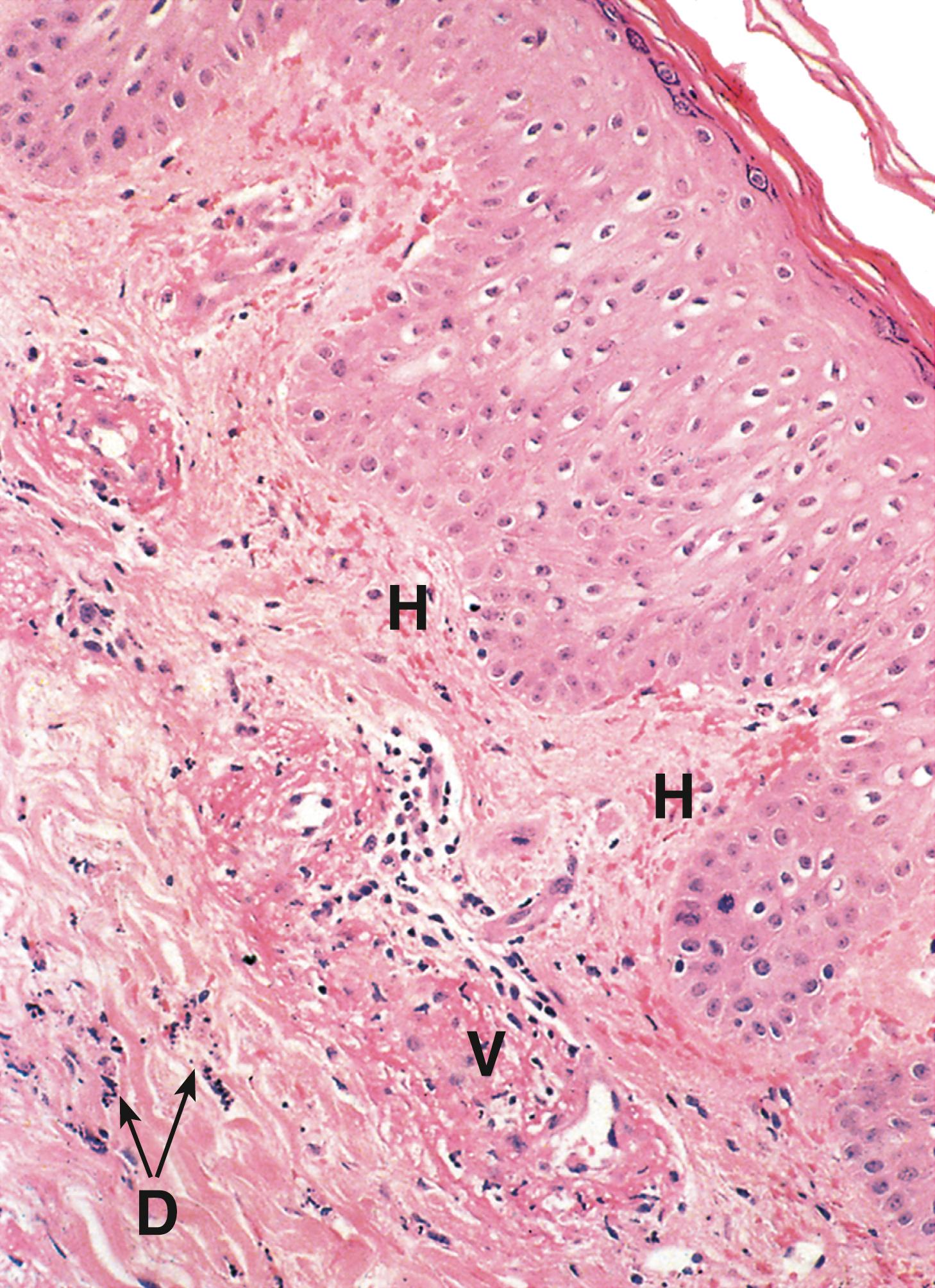 Fig. 11.7, Microscopic polyarteritis (MP).