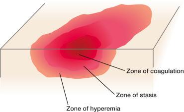 Fig. 6.3, Zones of injury.