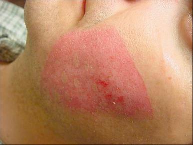 Fig. 6.6, Nonaccidental contact burn. This burn was caused by a clothes iron; note the triangular shape.