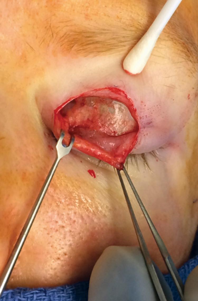 Fig. 56.7, The level of placement of the upper eyelid weight is in the plane immediately above the tarsal plate with dissection to the level of the lash follicles.