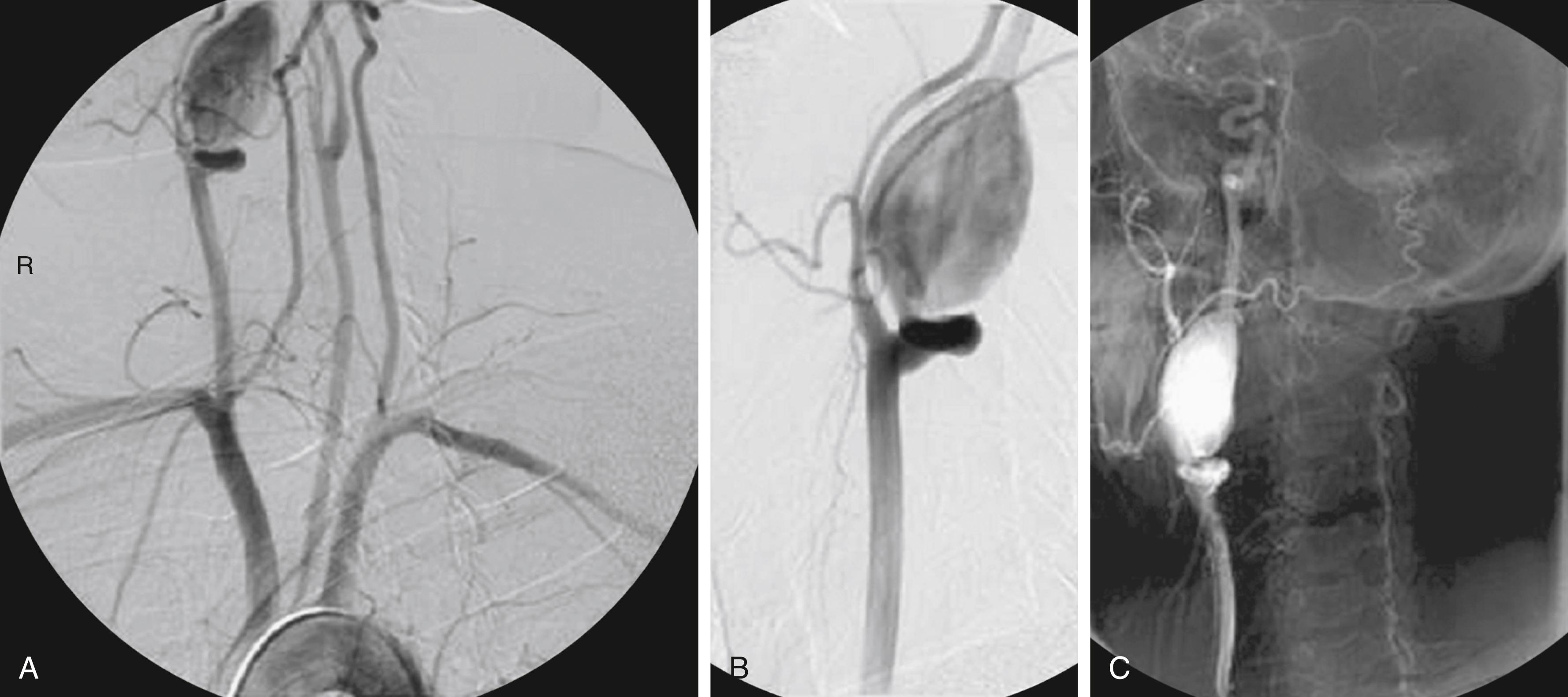 Figure 97.1, Arch ( A ) and right carotid ( B , C ) arteriograms showing a large extracranial carotid artery aneurysm involving the proximal internal carotid artery.