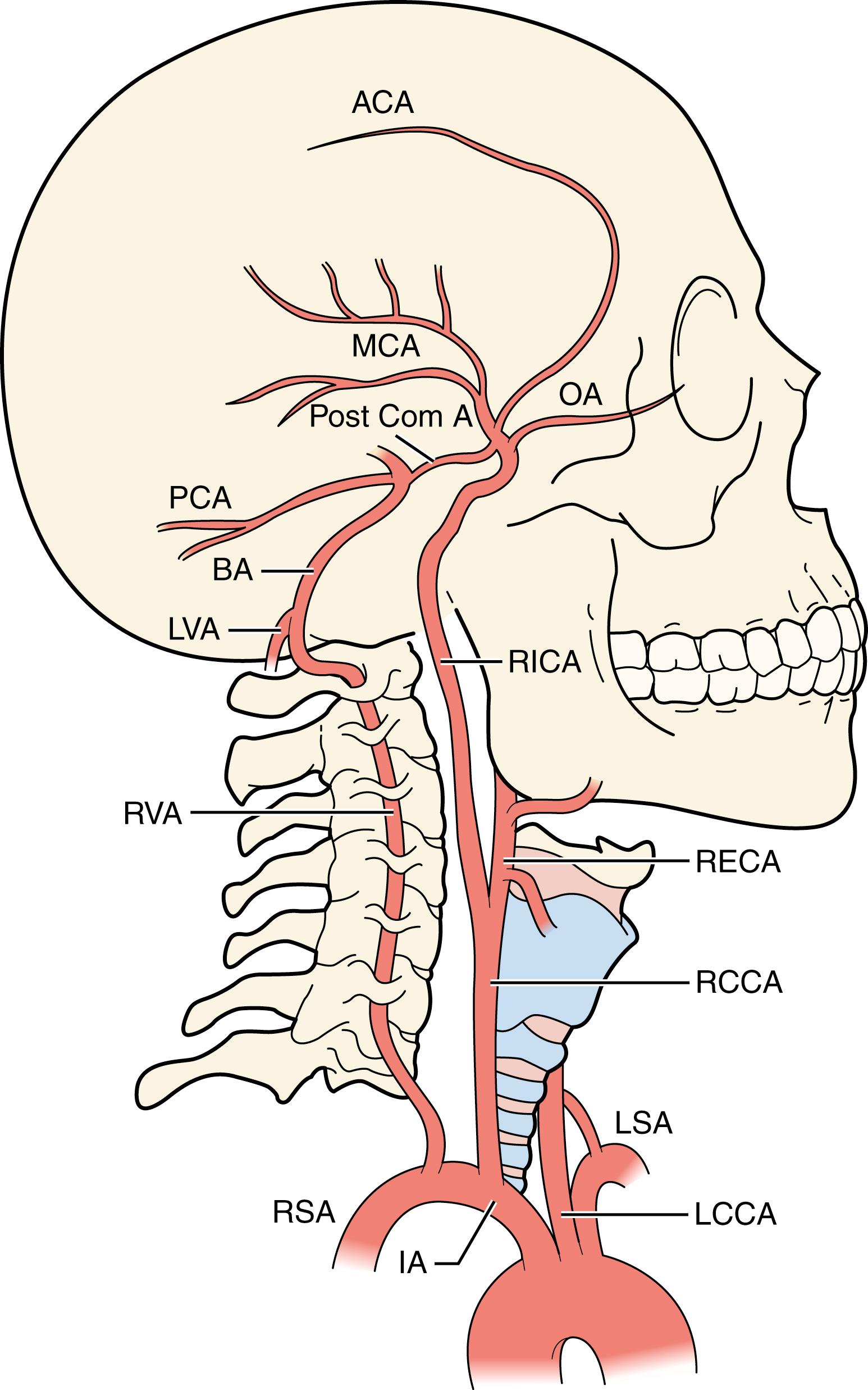 Fig. 22.1, Anatomy of the extracranial cerebral-bound arteries and their main intracranial supplies, lateral view from the right. ACA , Anterior cerebral artery; BA , basilar artery; IA , innominate artery; LCCA , left common carotid artery; LSA , left subclavian artery; LVA , left vertebral artery; MCA , middle cerebral artery; OA , ophthalmic artery; PCA , posterior cerebral artery; Post Com A , posterior communicating artery; RCCA , right common carotid artery; RECA , right external carotid artery; RICA , right internal carotid artery; RSA , right subclavian artery; RVA , right vertebral artery. The AChA is not depicted.