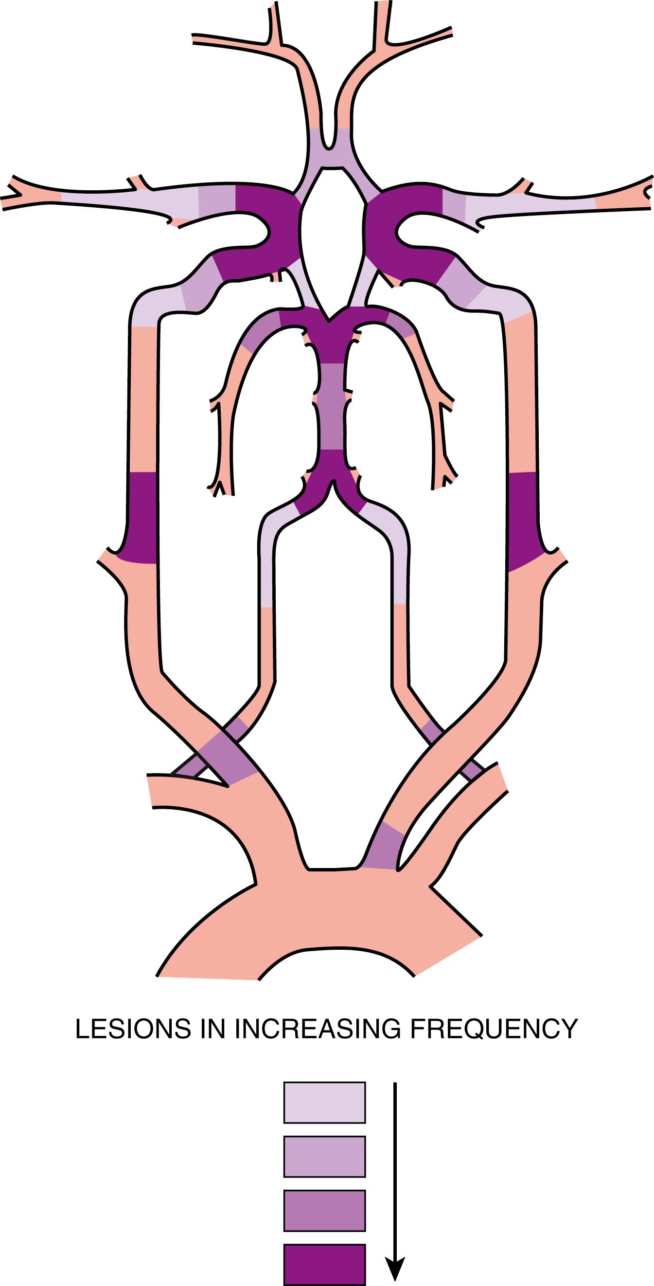 Fig. 22.2, Distribution of atherosclerotic lesions in the carotid and vertebrobasilar territories.