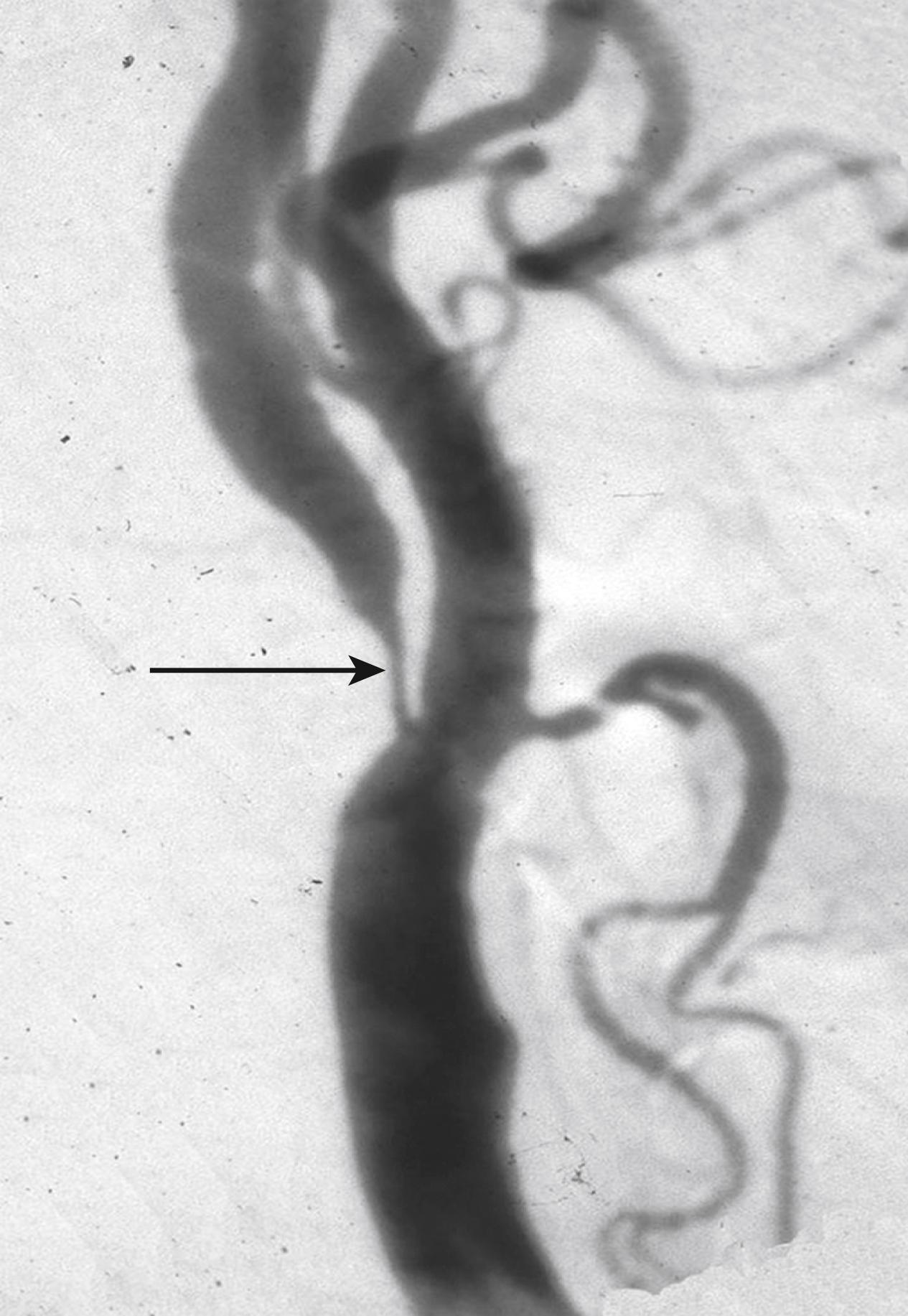 Fig. 22.3, Digital subtraction angiogram showing severe stenosis of the internal carotid artery extending a few centimeters from the carotid bifurcation (arrow) . The external carotid artery arising from the carotid bifurcation is easily recognized by its multiple branches. In contrast, the internal carotid artery has no branches in the neck.