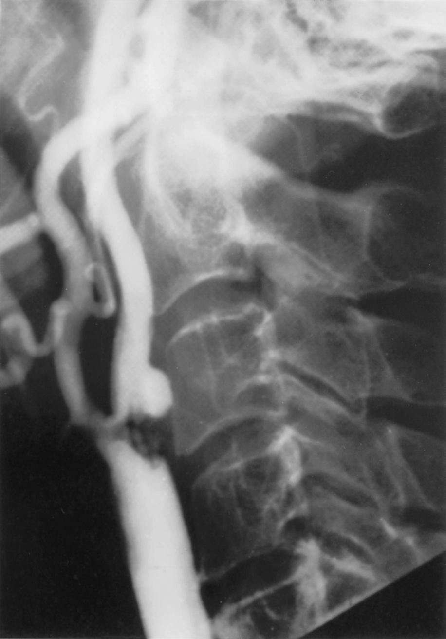 Fig. 22.6, Internal carotid artery with combined stenosis and large ulceration shown using the early technique of catheter-based angiography without digital subtraction of the structures seen on a noncontrast x-ray.