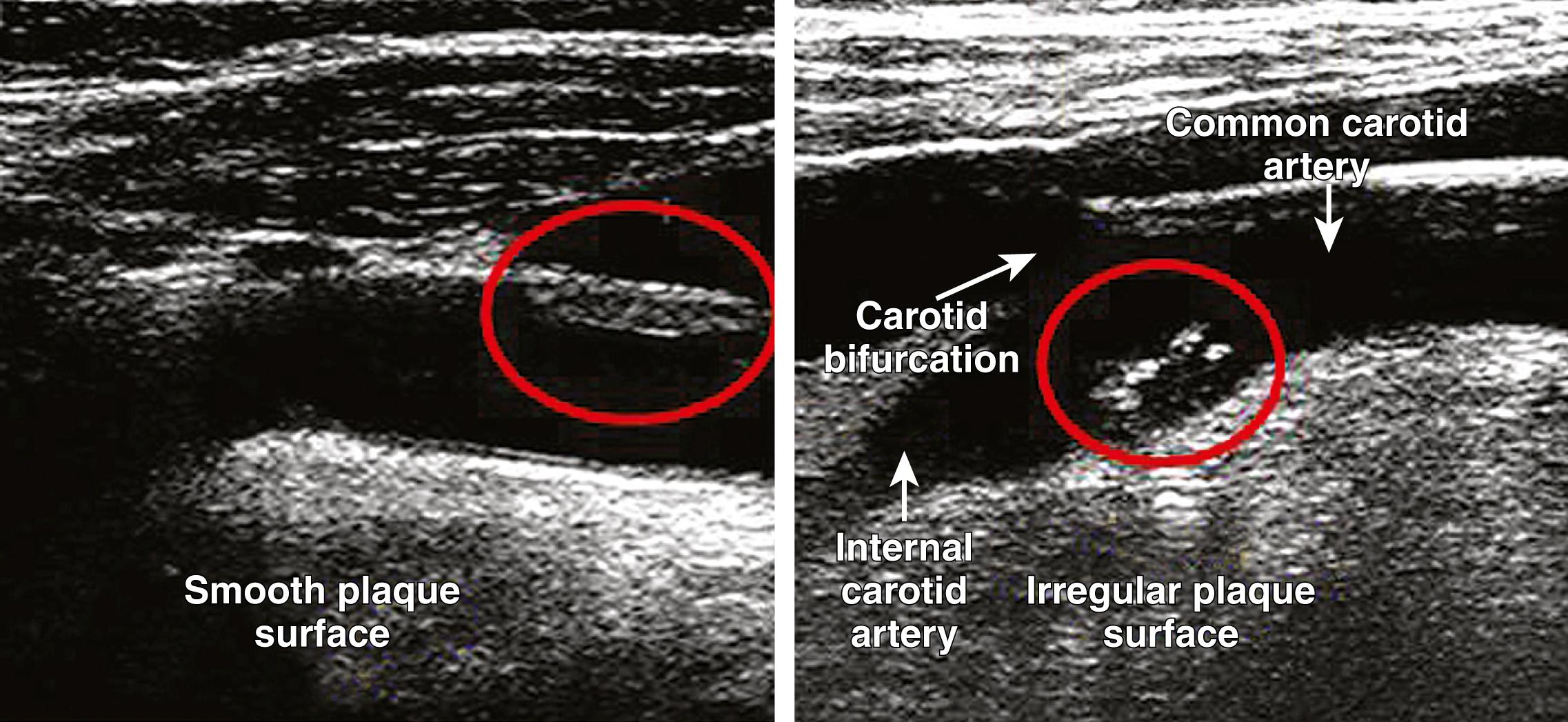 Fig. 22.7, Left panel, Regular carotid plaque surface seen as a smooth surface of thickened intima adjacent to the lumen (red oval) . Right panel, Irregular carotid plaque surface seen as domed projection into the lumen (red oval) .