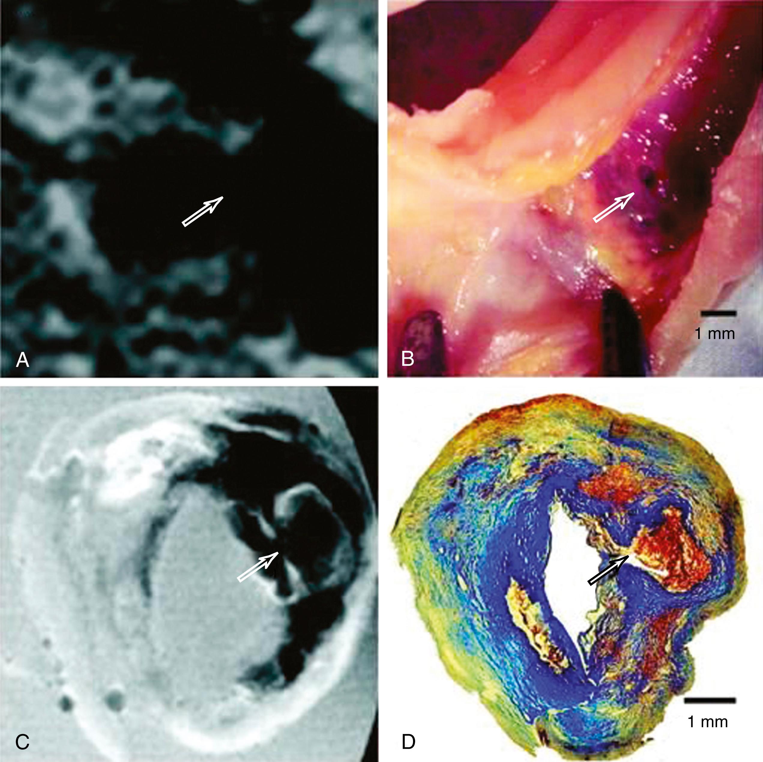 Fig. 22.8, Rupture of an ulcerated left internal carotid artery atherosclerotic stenosis. (A) In vivo T 1 -weighted MRI at 3T showing the area of maximal luminal reduction communicating with an ulcer crater (arrow) . The widening of the more normal lumen is seen at the top of the image. (B) Gross inspection of the carotid endarterectomy specimen. (C) Ex vivo T 1 -weighted MRI at 11.7 T of the specimen showing rupture of the thinned fibrous cap ( arrow ), the slit-like lumen of the artery (crossed by the arrowhead ), and areas of hemorrhage and lipid-rich core within the plaque (dark areas of low signal). (D) Trichrome-stained specimen showing matched histology.