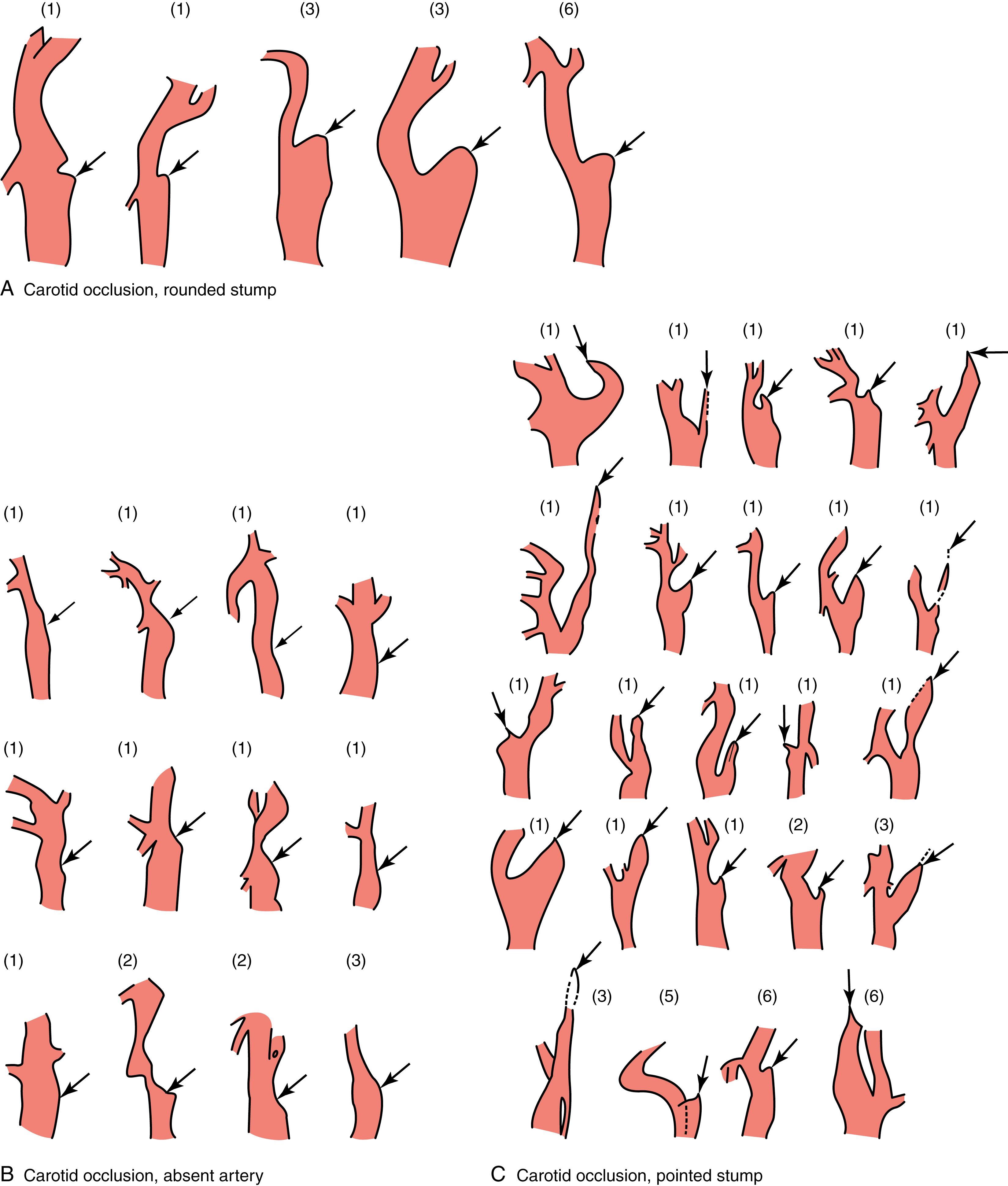 Fig. 22.10, Angiographic appearance of different types of internal carotid artery occlusion. Numbers in parentheses indicate days between stroke onset and angiography. (A) Carotid occlusion, rounded stump; (B) carotid occlusion, absent artery; and (C) carotid occlusion, pointed stump.