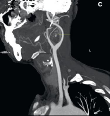 FIG 22.1, Carotid body tumor on computed tomography (CT) scan.