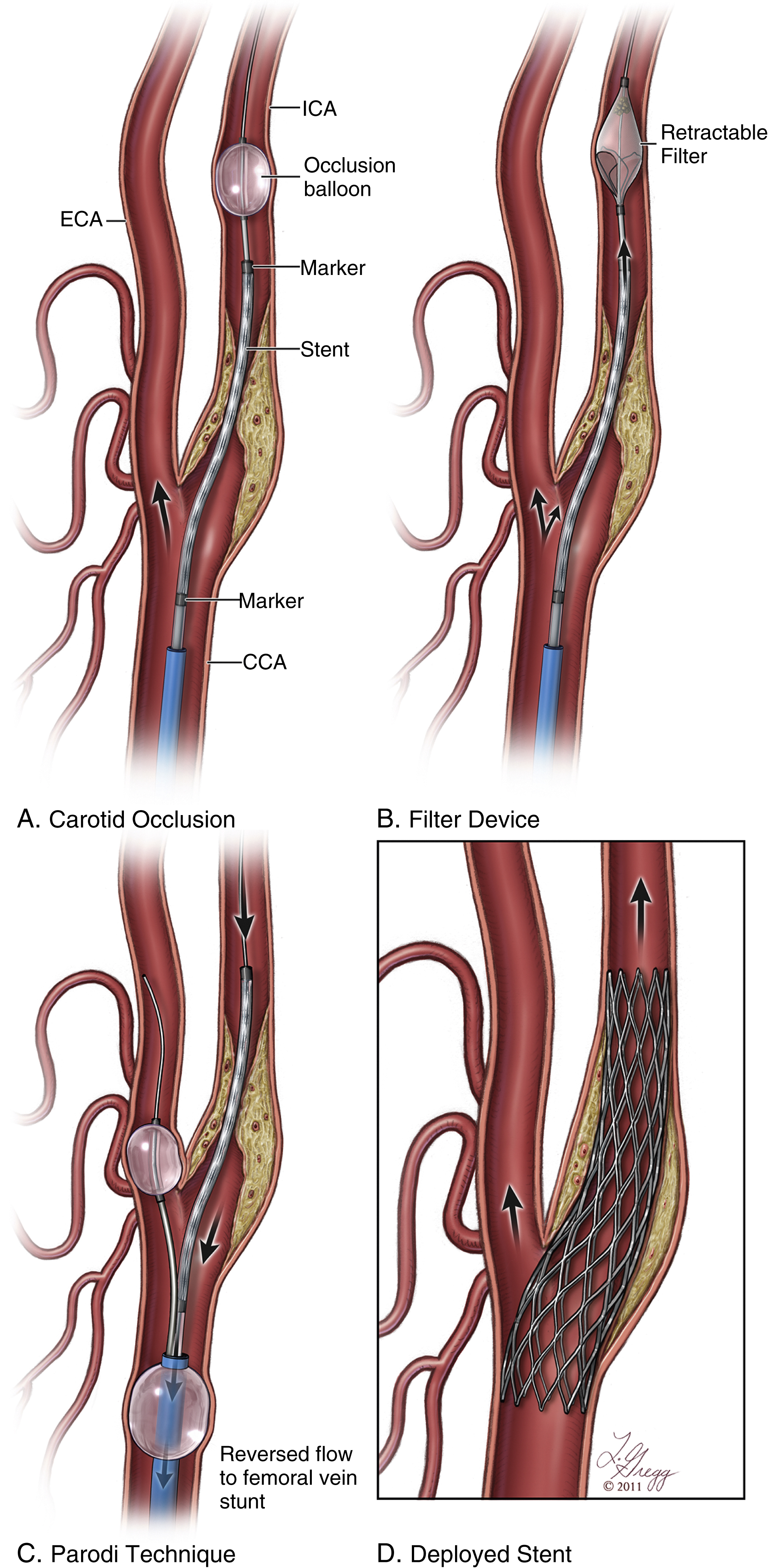 Fig. 60.1, (A)Theron technique. Procedure is performed under flow interruption obtained by inflating a balloon within the internal carotid artery ( ICA ). After placement of stent (and postdilatation if performed), delivery guide is advanced through the stent and placed immediately below inflated balloon. Blood stagnating below balloon (containing potential plaque debris) is aspirated forcefully. After aspiration, space below balloon is flushed with a bolus of saline solution that chases reminder of dead space content into external carotid artery. (B) Embolic protection device (EPD), filter-type. In this technique, filter is advanced through stenosis, using either its built-in wire tip or an over-the-wire technique with a wire selected by operator. Filter is deployed in the ICA and kept open for duration of procedure. At the end, a special recovery catheter is used to retrieve filter and its content. (C) EPD, flow-reversal type: with this technique, blood flow through lesion is reversed during the procedure, carrying potential debris away from cerebral circulation. Flow reversal is created by inflating two balloons, one in the common carotid artery ( CCA ) and one in external carotid artery ( ECA ), while blood leaving through the device is reinjected in a femoral vein. (D) Final result with stent deployed in the ICA, traversing the stenosis into the CCA.