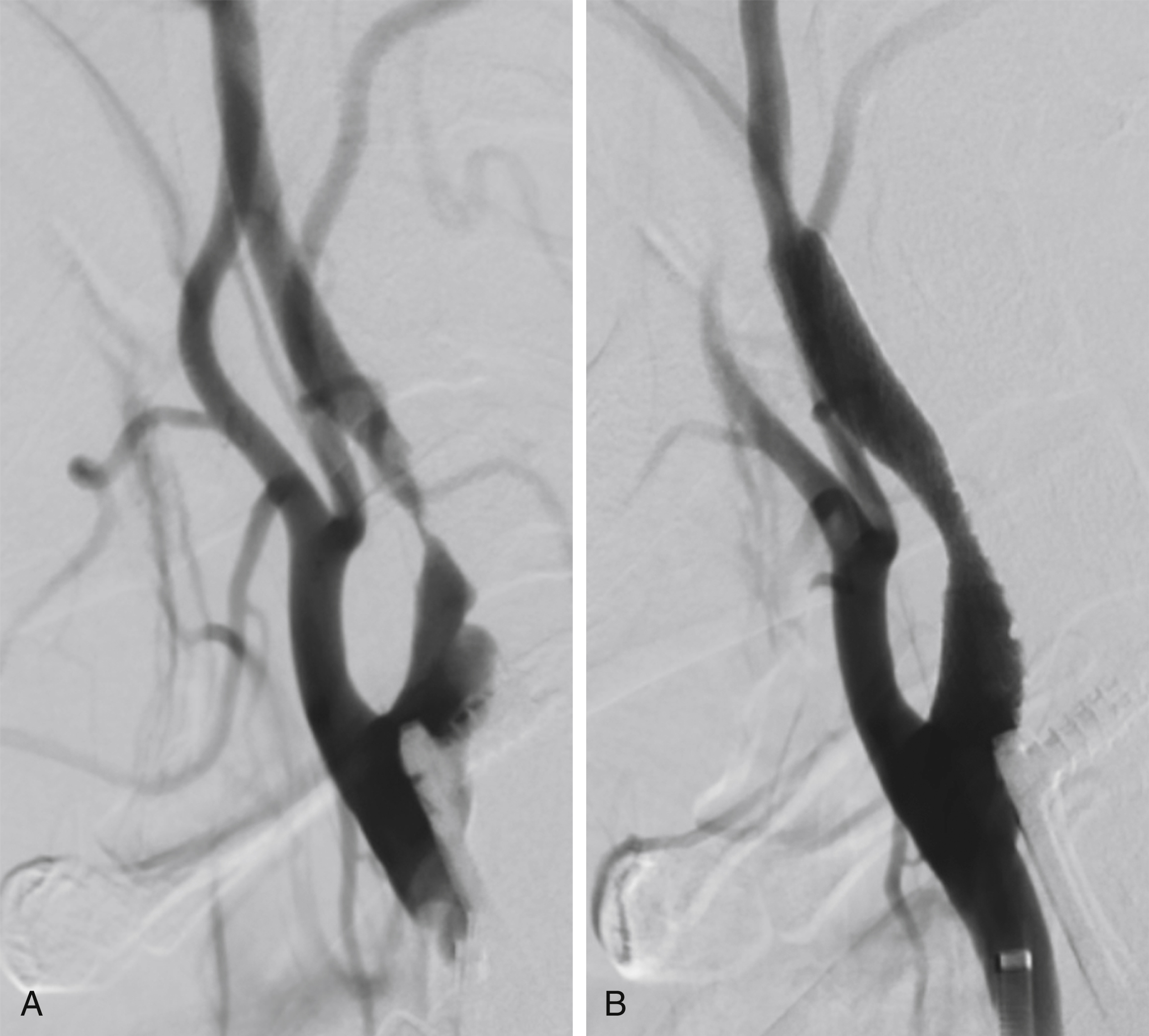 Fig. 60.2, This 51-year-old man had an occluded right internal carotid artery (ICA) and left subclavian artery and left ICA stenosis. (A) Before stent placement. Stenosis was predilated with 3 mm × 2 cm balloon. (B) After stenting with 8 mm × 40 cm stent. Poststent placement angioplasty was not performed.