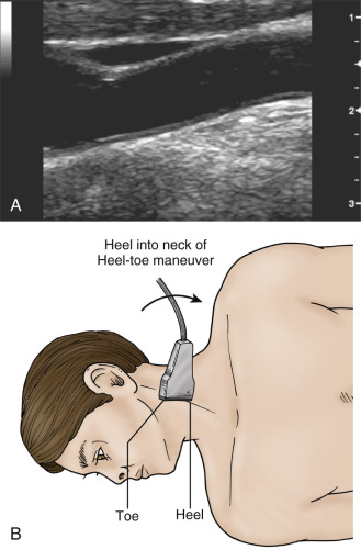 FIG. 5.2, (A) Although the transducer is still in the axis of the artery, the transducer face has been angled by the heel-toe maneuver. The angle between the ultrasound beam and the walls of the common carotid artery is no longer 90 degrees. This leads to a loss of the lumen-intima interface but facilitates Doppler waveform analysis because the angle between artery and ultrasound probe has increased. (B) The corresponding diagram shows the heel part of a heel-toe maneuver used to obtain this image.