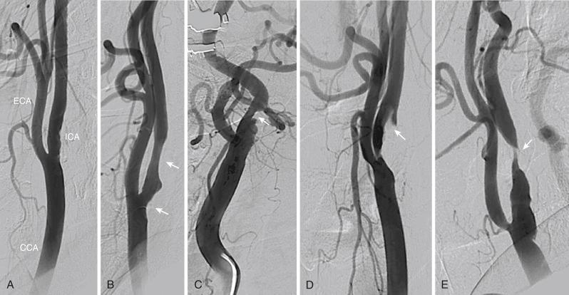 Fig. 46.2, Angiographic images from the carotid bifurcation show the spectrum of atherosclerotic disease at this site.