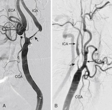 Fig. 46.5, Angiographic appearance of “near-occlusion” of the internal carotid artery (ICA) .