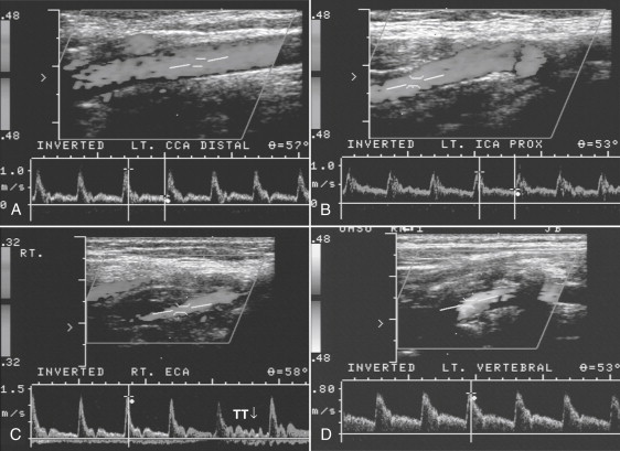 Carotid and Vertebral Arteries - Clinical Tree