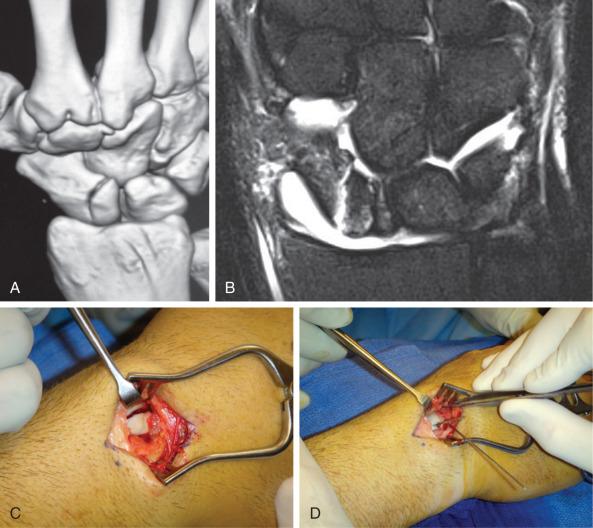 Fig. 70.1, A displaced fracture of the proximal third of the scaphoid in a Major League Baseball player. (AB) Magnetic resonance imaging and three-dimensional computed tomography reconstruction can aid in identifying the fracture pattern. (C) A mini-open approach was used through a 1- to 2-cm dorsal incision. (D) The fracture was reduced using K-wires as joysticks and fixed with a cannulated screw down the central axis of the scaphoid.