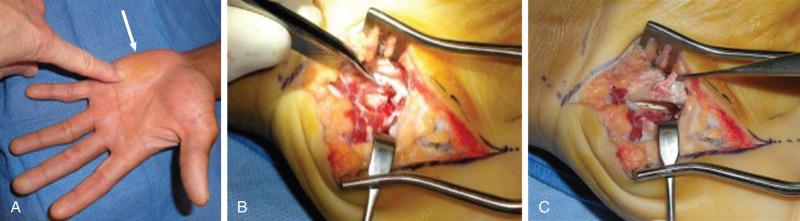 Fig. 70.11, (A) A callus (arrow) over the hypothenar eminence in a baseball player with flexor tendonitis and ulnar-sided palm pain. (B) A fracture was found over the distal margin of the hamate at the carpometacarpal joint. The hamate hook was not fractured. (C) A partial flexor tendon laceration was encountered from abrasion against the fractured hamate.