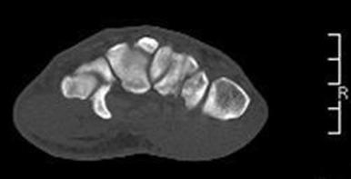 Fig. 70.12, A computed tomography image of the carpal canal demonstrating a hook of the hamate fracture.