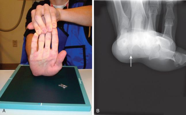 Fig. 70.13, (A) A hand held in maximum extension to obtain the carpal tunnel view. (B) The carpal tunnel view demonstrates the hamate hook (arrow) .