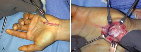 Fig. 70.14, (A) Exposure of the hamate hook through a curvilinear incision in the palm. (B) Exposed hamate hook.