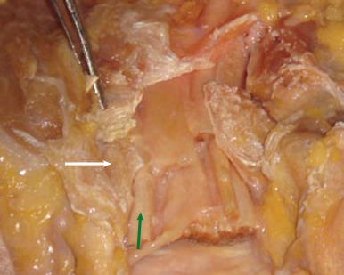 Fig. 70.3, Anatomic dissection revealing the proximity of the trapezial ridge (white arrow) to the flexor carpi radialis tendon (green arrow) .