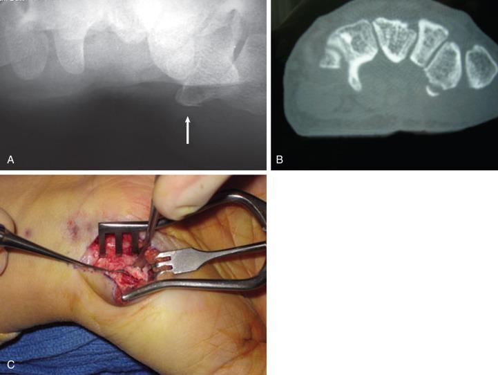 Fig. 70.5, (A) The carpal tunnel view demonstrating a fracture of the trapezial ridge (arrow) . (B) A computed tomography scan demonstrating fracture of the trapezial ridge. (C) The incision near the base of the thenar eminence with resection of the fractured trapezial ridge.