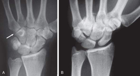 Fig. 70.9, (A) Posteroanterior plain radiographs of the wrist allow visibility of the joint space between the base of the fifth metacarpal and the hamate (arrow) . (B) Obliteration of the joint space in a patient with a III to V carpometacarpal fracture dislocation.