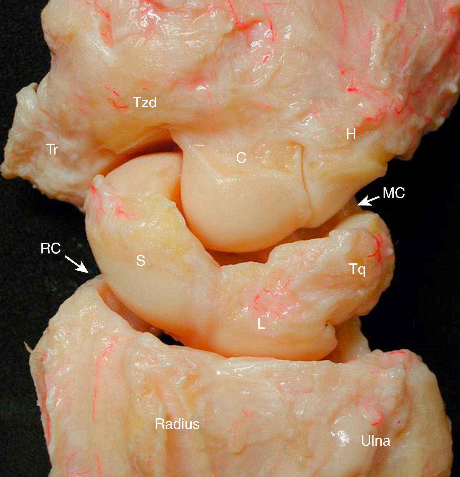 Fig. 13.1, Frontal view of a dissected cadaver specimen showing the proximal row intercalated between the distal row and the two forearm bones. The radiocarpal (RC) and midcarpal (MC) joints are defined as the proximal and distal articular interfaces of the proximal row. C, Capitate; H, hamate; L, lunate; S, scaphoid; Tq, triquetrum; Tr, trapezium; Tzd, trapezoid.