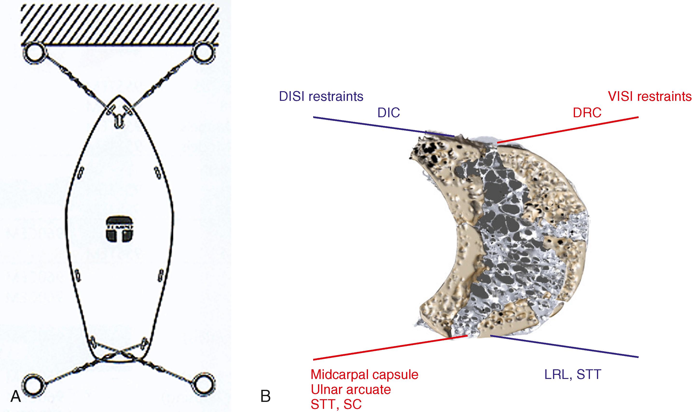 Fig. 13.11, A , Like the most stable configuration of a boat at mooring, the lunate has four “critical ligament stabilizers” (two dorsal, two palmar, two radiocarpal, and two midcarpal) ensuring its postural stability, even when the scapholunate or lunotriquetral ligaments have been divided in isolation. B, Ruptures or attenuation of one or more of these ligament stabilizers lead to dissociative or nondissociative postural deformities of the bones of the proximal carpal row. DIC, Dorsal intercarpal ligament; DISI, dorsal intercalated segmental instability; DRC, dorsal radiocarpal; LRL, long radiolunate; STT, scaphotrapeziotrapezoid; SC, scaphocapitate; VISI, volar intercalated segmental instability.