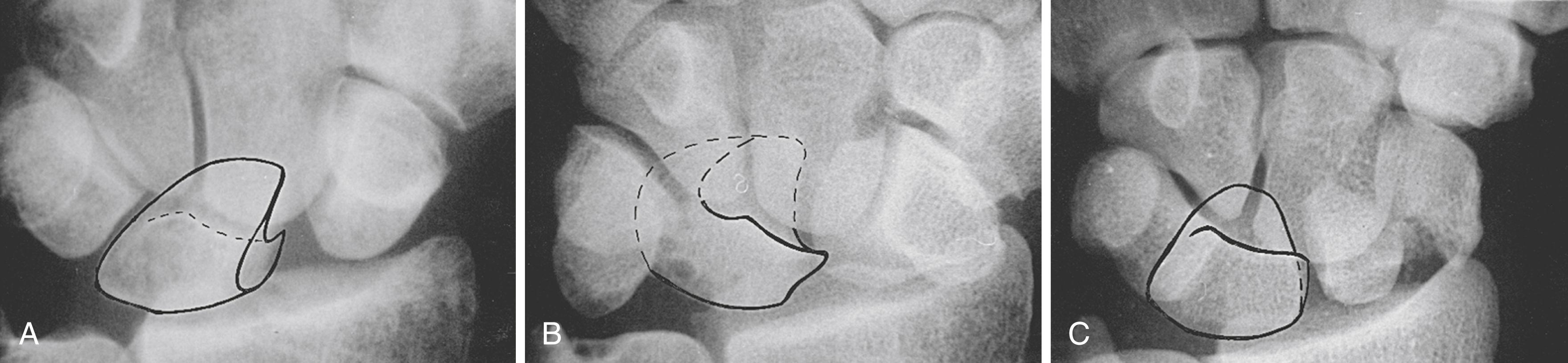 Fig. 13.16, The shape of the lunate on a posteroanterior view may help differentiate a dislocated from a malaligned lunate. A, The lunate in a dorsal intercalated segment instability (DISI) position tends to have an ovoid configuration, with a prominent ulnar corner pointing toward the medial aspect of the wrist. B, The lunate in volar intercalated segment instability (VISI) has a “C”-shaped or moon-like appearance. C, In dorsal perilunate dislocations, the subluxed lunate appears as an isosceles triangle pointing distally.