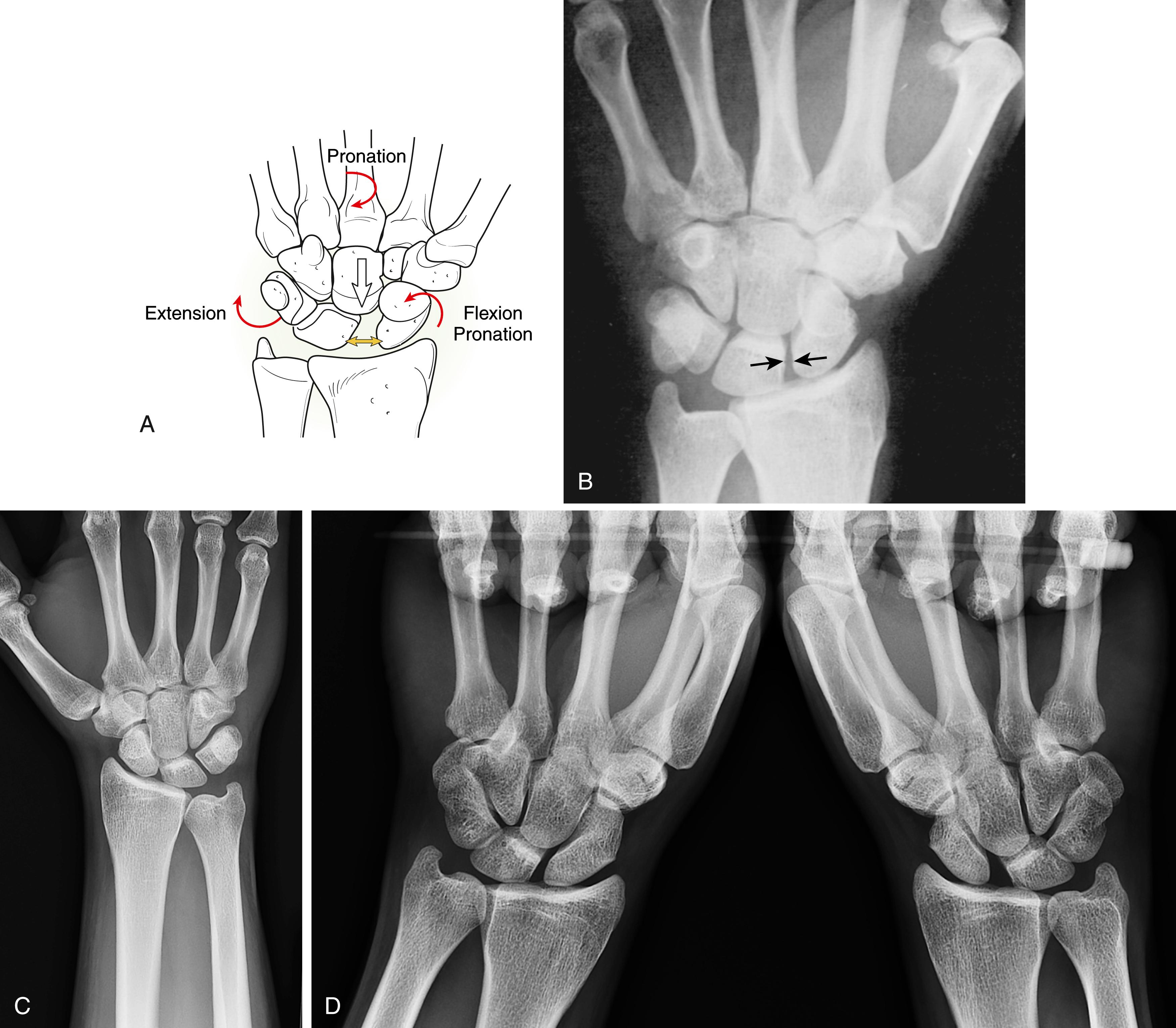 Fig. 13.17, A, Schematic representation of the most frequent displacements (red curved arrows) exhibited by an SL dissociation under axial load in a supinated AP grip radiograph (white arrow) : The scaphoid tends to rotate into flexion and slight pronation; the unconstrained triquetrum and lunate extend (dorsal intercalated segment instability [DISI]); the distal carpal row pronates and a gap appears between the scaphoid and lunate (yellow double arrow) . B, The scapholunate space is clearly shown in a PA pronated view with the tube angled 10 degrees from the ulnar side. The gap is measured in its midportion, the landmark being the middle of the flat medial facet of the scaphoid (arrows) . C, PA pronated view of an injured and symptomatic wrist demonstrating no appreciable scapholunate gap. D, Bilateral pronated “pencil grip” PA view of the same patient demonstrating dramatic widening of the injured scapholunate interval under load, and with the joint profiled by this view’s increased pronation.