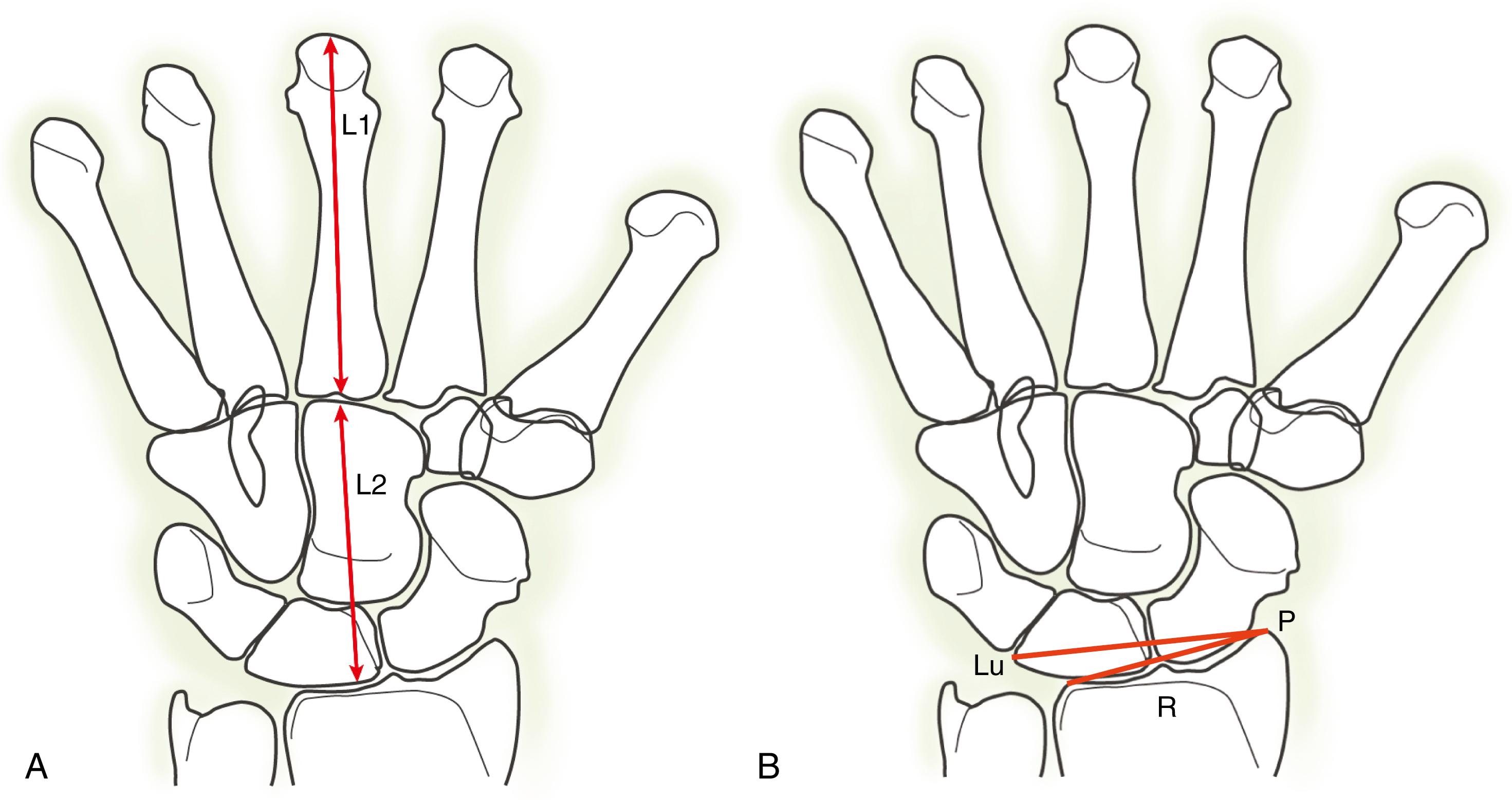 Fig. 13.19, A, Carpal height ratio is calculated by dividing the carpal height (L2) by the length of the third metacarpal (L1) . The normal ratio is 0.54 ± 0.03.117. B, To measure lunate translocation, Bouman and associates described a ratio of a line measuring the length of the articular surface of the radius (R) divided by the distance from the radial styloid to the proximal ulnar corner of the lunate (P-Lu). In normal wrists, this equates to 0.87 ± 0.04. This method is dependent on the wrist being precisely positioned in neutral as well as normal distal radius and carpal anatomy as any changes in these parameters can affect the measurements.