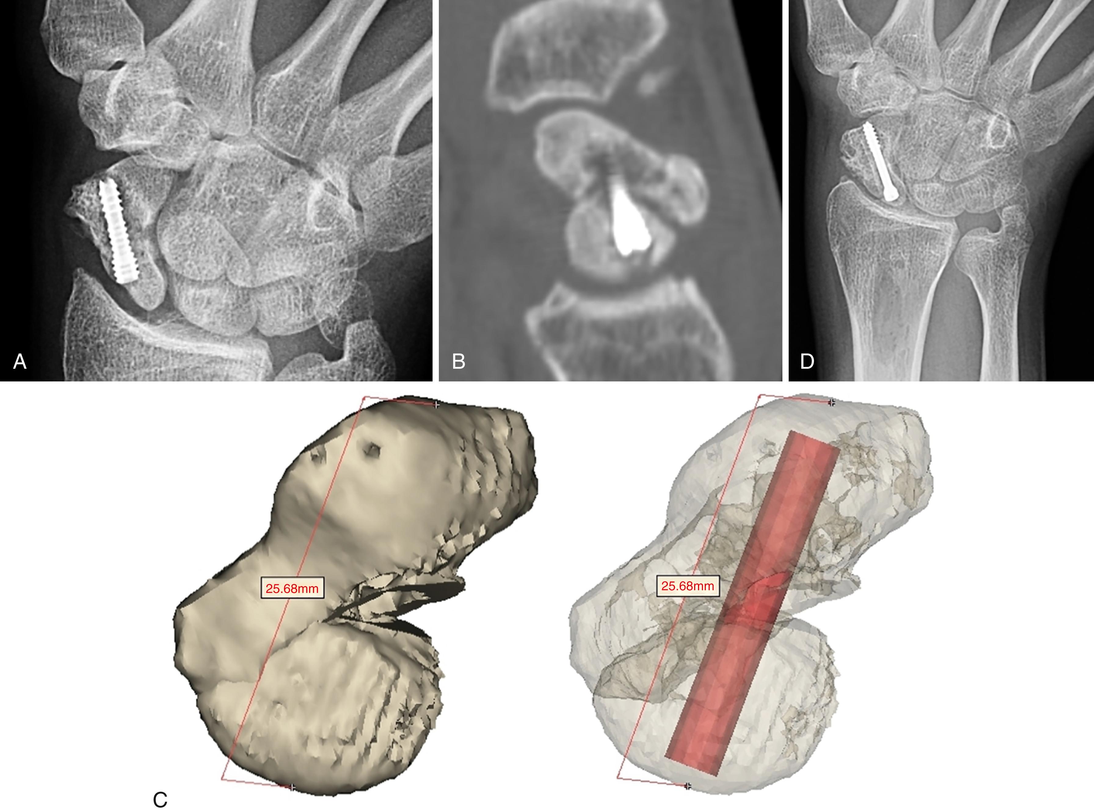 Fig. 13.20, A, Scaphoid view of a 16-year-old male with persistent nonunion and scaphoid nonunion advanced collapse (SNAC) I arthritis following internal fixation a year ago. B, 2D computed tomography demonstrates complex collapse deformity and bone loss. C, 3D mesh reconstruction and segmentation of the fracture fragments allows preoperative subtraction of the screw, anatomic repositioning of the fragments, and calculation of new screw size and trajectory. D, Healed scaphoid following hybrid Russe corticocancellous graft and radial styloidectomy 6 months postoperatively (note autograft defect in distal radial metaphysis).