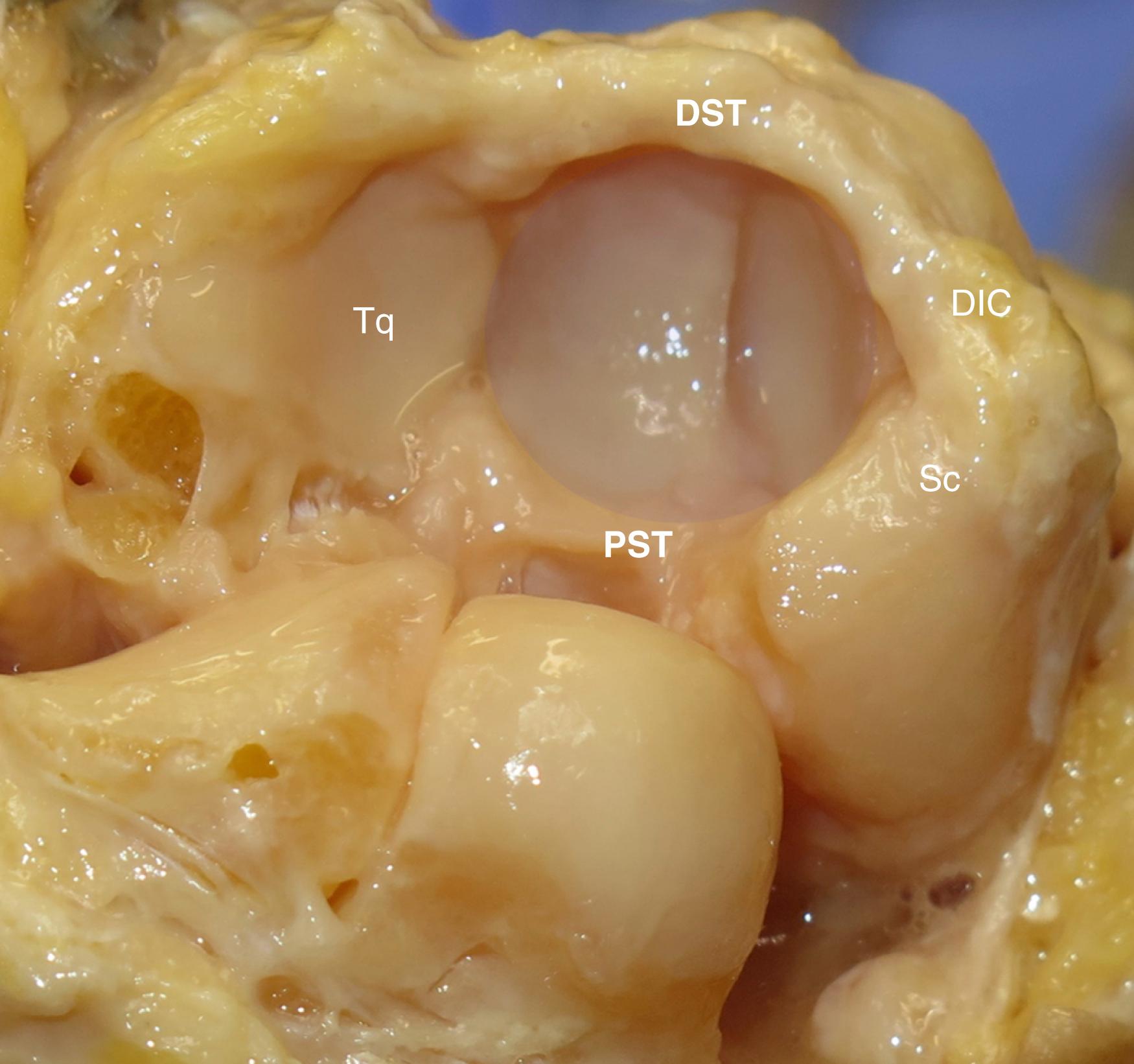 Fig. 13.2, The carpus has been “shotgunned” open at the midcarpal articulation to reveal the nearly spherical concave receptacle for the capitate-hamate joint (shaded). The dorsal (DST) and palmar (PST) scaphotriquetral ligaments create labrums that further stabilize the joint and effectively couple dorsal and palmar translation moments of the distal row with rotation of the proximal row. DIC, Dorsal intercarpal ligament; Sc, scaphoid; Tq, triquetrum.