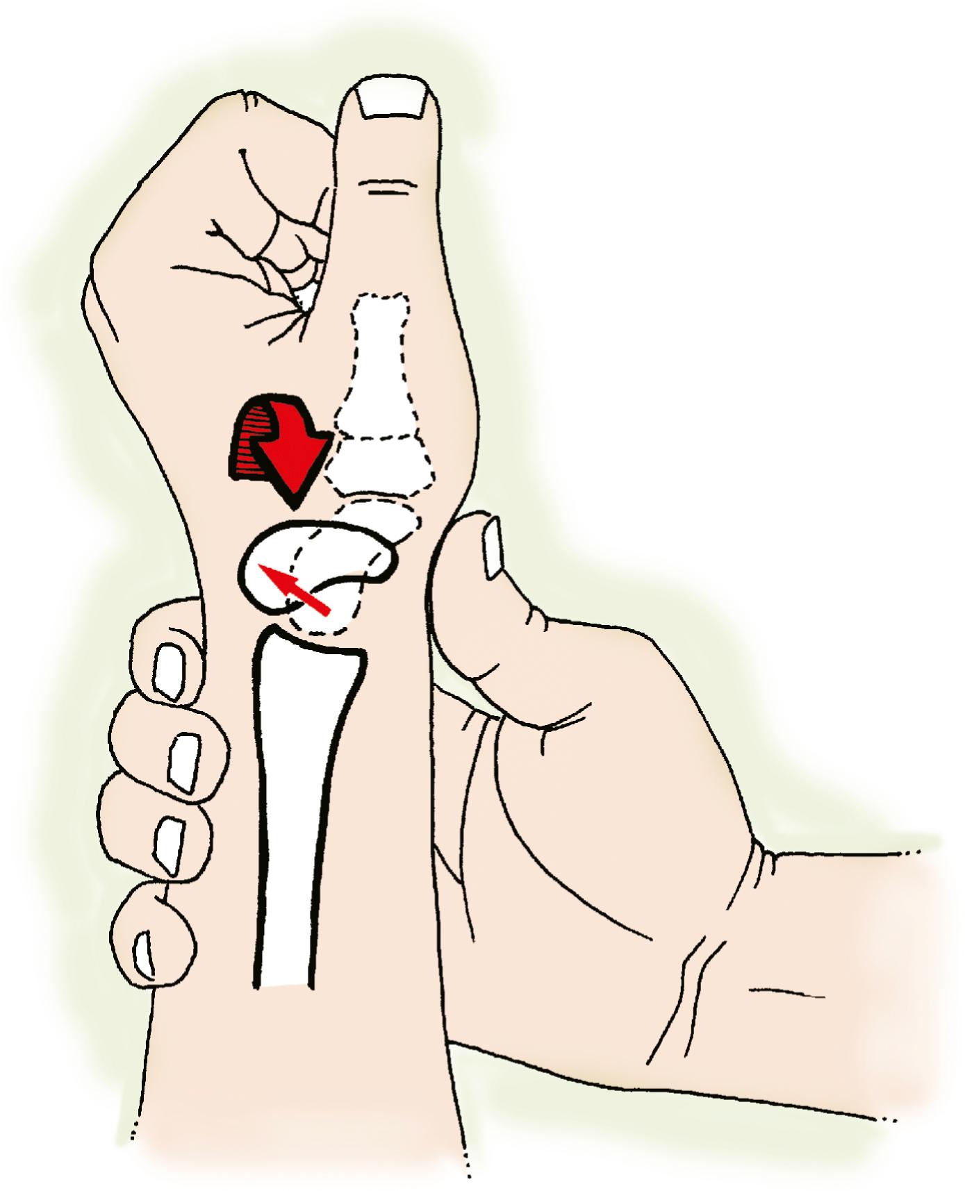 Fig. 13.22, Watson and colleagues 111 described the scaphoid shift test. Firm pressure is applied to the palmar tuberosity of the scaphoid while the wrist is moved from ulnar to radial deviation (curved arrow) . In normal wrists, the scaphoid cannot flex because of the external pressure by the examiner’s thumb. This may produce pain on the dorsal aspect of the scapholunate interval owing to synovial irritation. A “positive” test is seen in a patient with an SL tear or in a patient with a lax wrist; the scaphoid is no longer constrained proximally and subluxates out of the scaphoid fossa (straight arrow) . When pressure on the scaphoid is removed, it goes back into position and typically a clunk occurs.