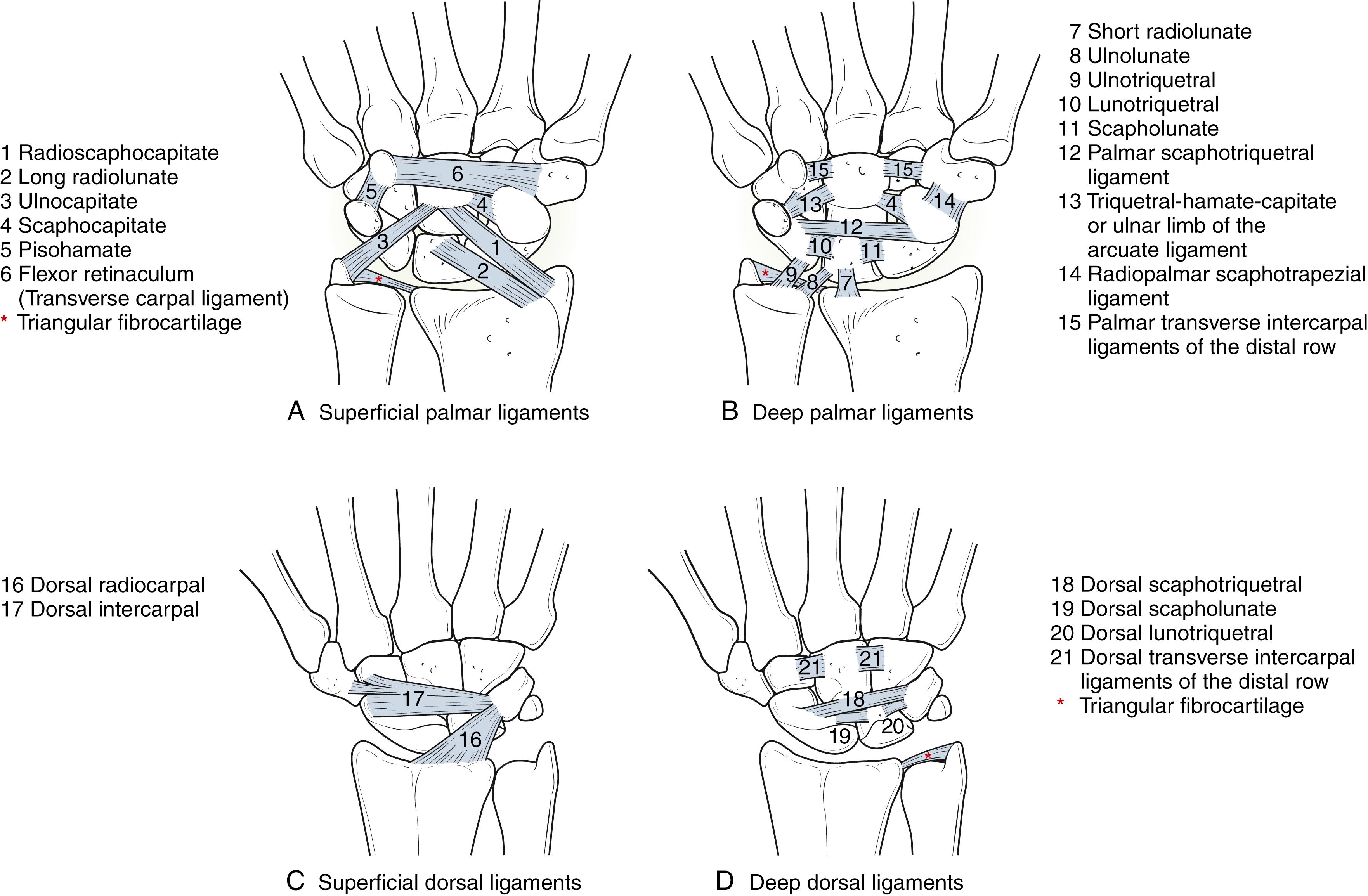 Fig. 13.3, Schematic representation of wrist ligaments. These drawings do not replicate the exact shape and dimensions of the actual ligaments or their frequent anatomic variations. A, Superficial palmar ligaments: radioscaphocapitate (1) ; long radiolunate (2) ; ulnocapitate (3) ; scaphocapitate (4) ; pisohamate (5) ; and flexor retinaculum or transverse carpal ligament (6) . B, Deep palmar ligaments: short radiolunate (7) ; ulnolunate (8) ; ulnotriquetral (9) ; lunotriquetral (10) ; scapholunate (11) ; palmar scaphotriquetral ligament (12) ; triquetral-hamate-capitate, also known as the ulnar limb of the arcuate ligament (13) ; radiopalmar scaphotrapezial ligament (14) ; and palmar transverse intercarpal ligaments of the distal row (15) . C, Superficial dorsal ligaments: the dorsal radiocarpal (16) ; the dorsal intercarpal ligament (17) . D, Deep dorsal ligaments: dorsal scaphotriquetral ligament (18) ; dorsal scapholunate (19) ; dorsal lunotriquetral (20) ; and the dorsal transverse intercarpal ligaments of the distal row (21) . Red asterisk, triangular fibrocartilage complex.