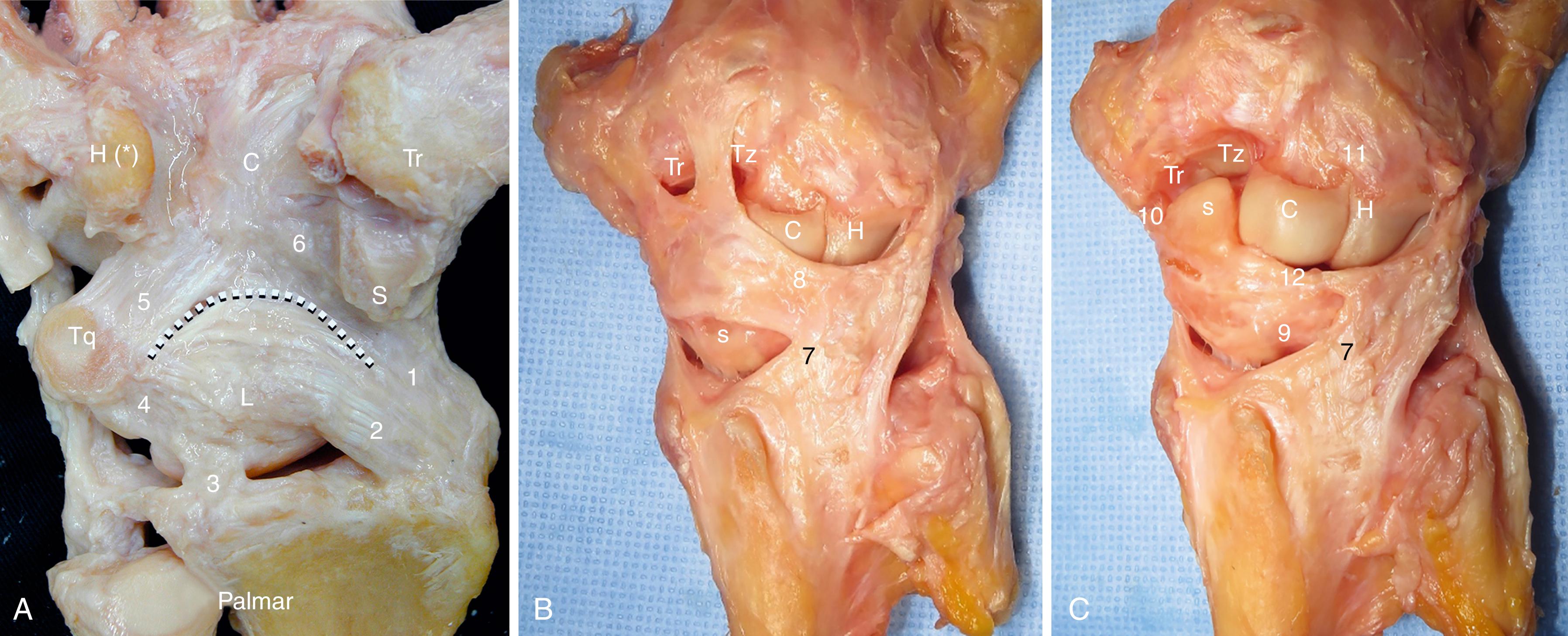 Fig. 13.4, Human cadaver wrist dissected to show the relationship of some ligaments with the underlying joint surfaces. A, Palmar view: radioscaphocapitate (1) ; long radiolunate (2) ; short radiolunate (3) ; palmar lunotriquetral (4) ; ulnar arcuate ligament (5) ; scaphocapitate (6) . The so-called space of Poirier (white dotted line) is a relatively weak interligamentous sulcus through which most perilunate dislocations occur. B, Dorsal view, superficial ligaments with radiocarpal and midcarpal capsular “windows” excised: dorsal radiocarpal (7) ; dorsal intercarpal (8) . Note the expansive insertion of the DIC on the scaphoid dorsal ridge, the trapezium, and the trapezoid. C, Dorsal view, deep ligaments: dorsal radiocarpal (7) ; scapholunate (9) ; scaphotrapeziotrapezoid (10) ; dorsal transverse intercarpal (11) ; dorsal scaphotriquetral (12) . Note the interdigitation of the dorsal ligaments over the lunate attachment site and the robust augmentation of the dSLIL by the dorsal scaphotriquetral ligament. Asterisk, hook of the hamate; C, Capitate; H, hamate; L, lunate; S, scaphoid; Tq, triquetrum; Tr, trapezium; Tz, trapezoid.