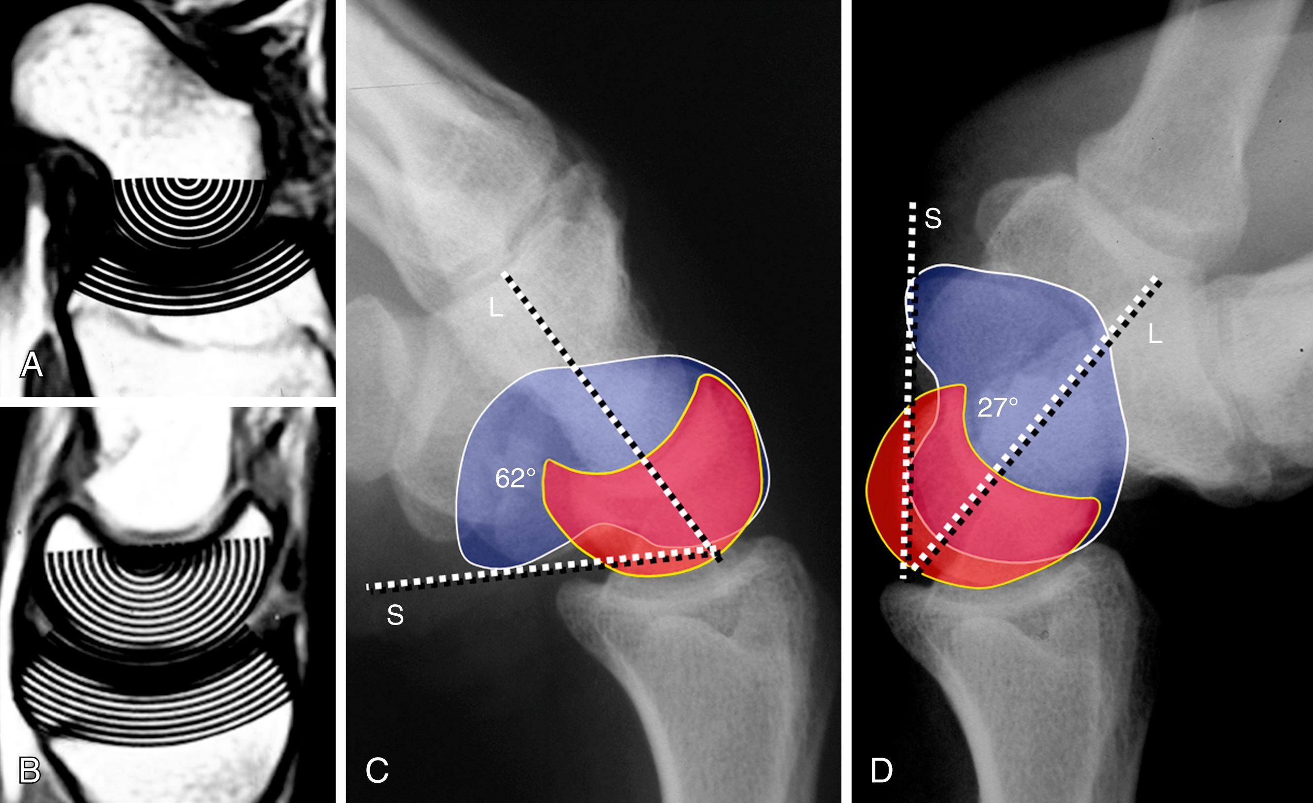 Fig. 13.7, Sagittal computed tomography scans of the scaphoid (A) and lunate (B) , covered by a transparent card with concentric circle scale marks. Indeed, the radius of curvature of the lunate (L) is longer than that of the scaphoid (S). Because of this, the scaphoid needs to rotate more than the lunate to get to the limits of flexion-extension. Unlike the distal row, where the four bones form a fixed unit with little motion between them, the proximal row exhibits substantial SL and lunotriquetral rotations. The proof of this may be found by comparing the SL angle in full flexion (C) and full extension (D) . In this particular case the scaphoid rotates 35 degrees more than the lunate. Note how the capitate stays concentrically reduced in the acetabular fossa of the midcarpal joint throughout flexion and extension.