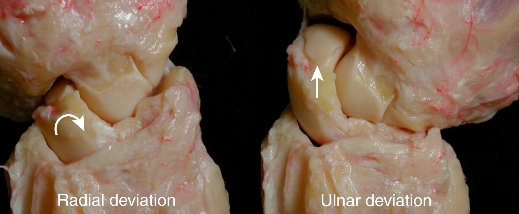 Fig. 13.8, Direction of rotation of the proximal carpal row during radial to ulnar rotation of the wrist in the frontal plane. From neutral to radial deviation of the wrist the trapezium and trapezoid push the scaphoid into flexion. This results in flexion and ulnar deviation of the entire proximal row (curved arrow) . During ulnar deviation the hamate is the one that exerts compression onto the triquetrum, inducing extension, ulnar deviation, and slight pronation of the entire proximal row, through its unique “helicoidal” articulating surface. The scaphoid, consequently, adopts an extended posture (straight arrow) . The amounts of flexion-extension rotation of the scaphoid and ulnar-radial translation of the lunate, however, differ from one patient to another.