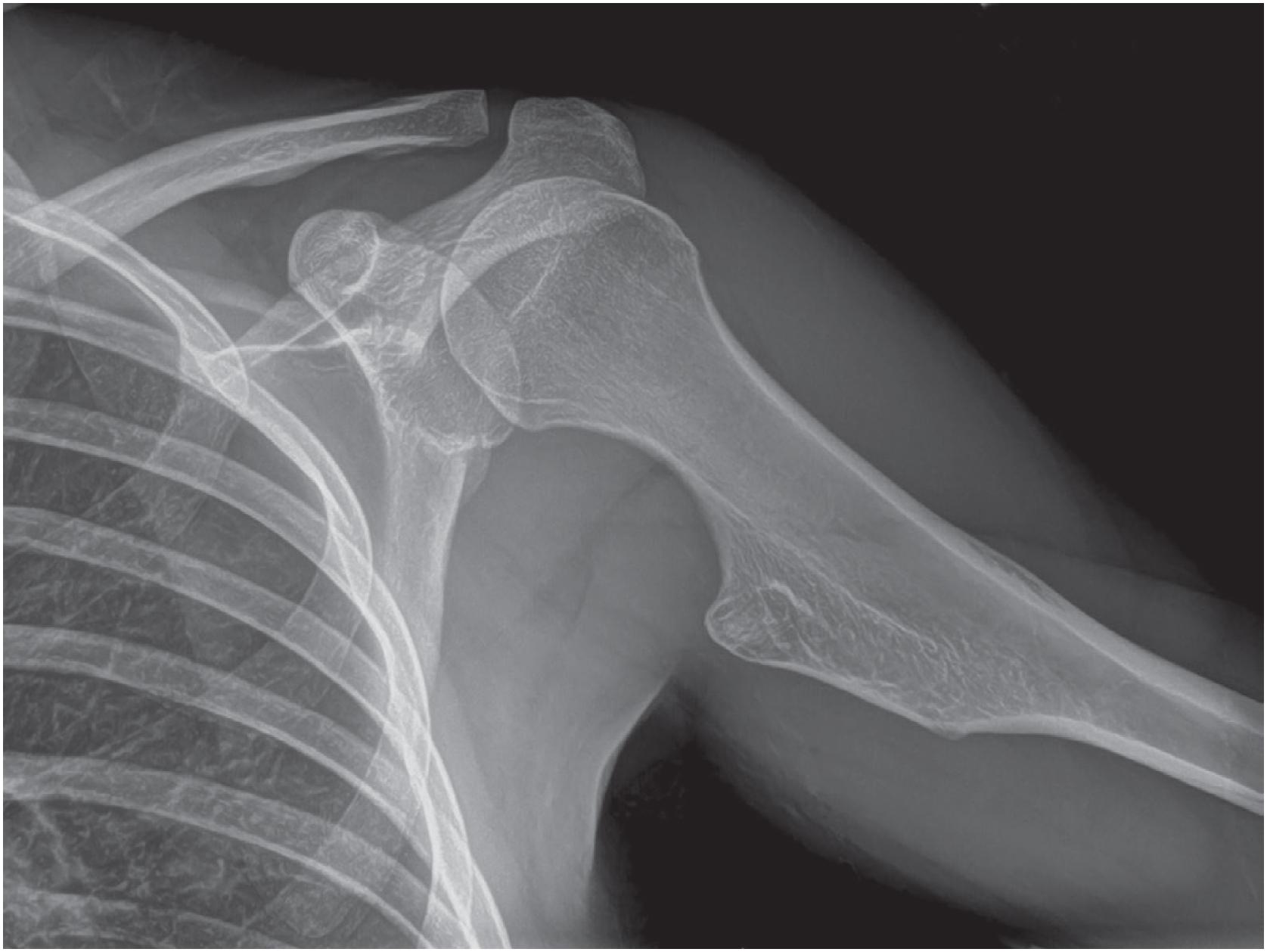 Fig. 17.5, Radiograph shows a sessile osteochondroma arising from the cortex of the proximal humerus. There is contiguity between the cortex of the lesion and that of the underlying humerus.