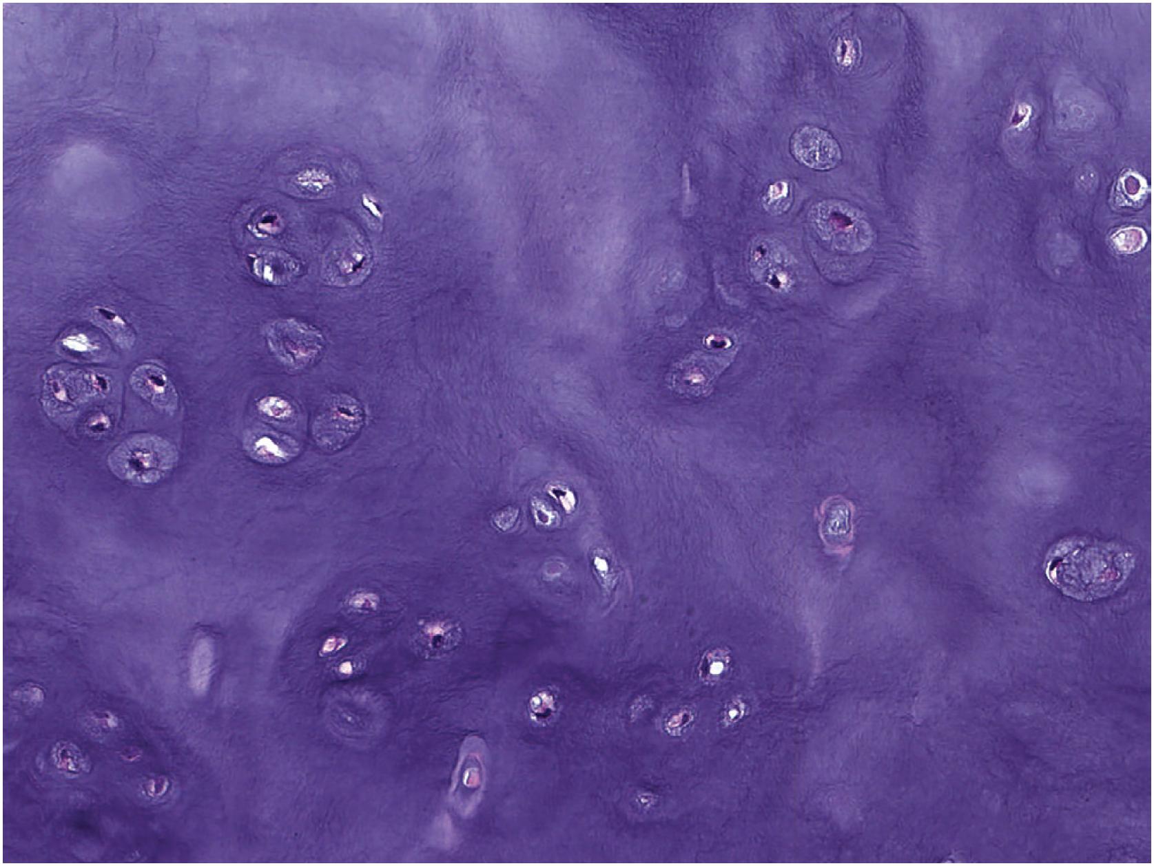 Fig. 17.15, At high power, the chondrocytes within osteochondroma are small with dark nuclei and lack cytologic atypia.