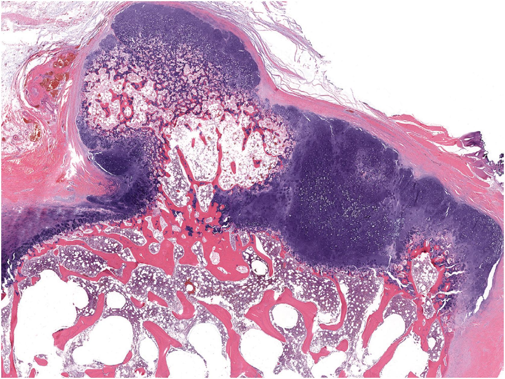 Fig. 17.16, This osteochondroma from a pediatric patient demonstrates cellular hyaline cartilage with endochondral ossification reminiscent of primary spongiosa. These features are seen in tumors affecting the growing skeleton.