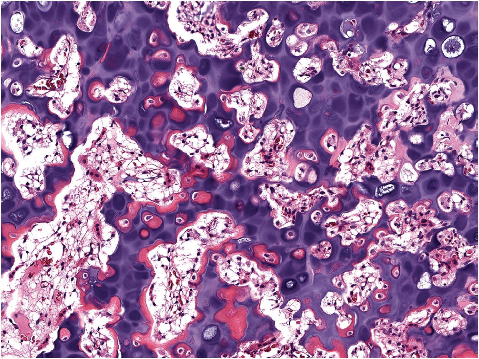 Fig. 17.17, At high power, the primary spongiosa-like tissue of a growing enchondroma consists of cartilaginous cores sandwiched by bone and fibrovascular tissue.