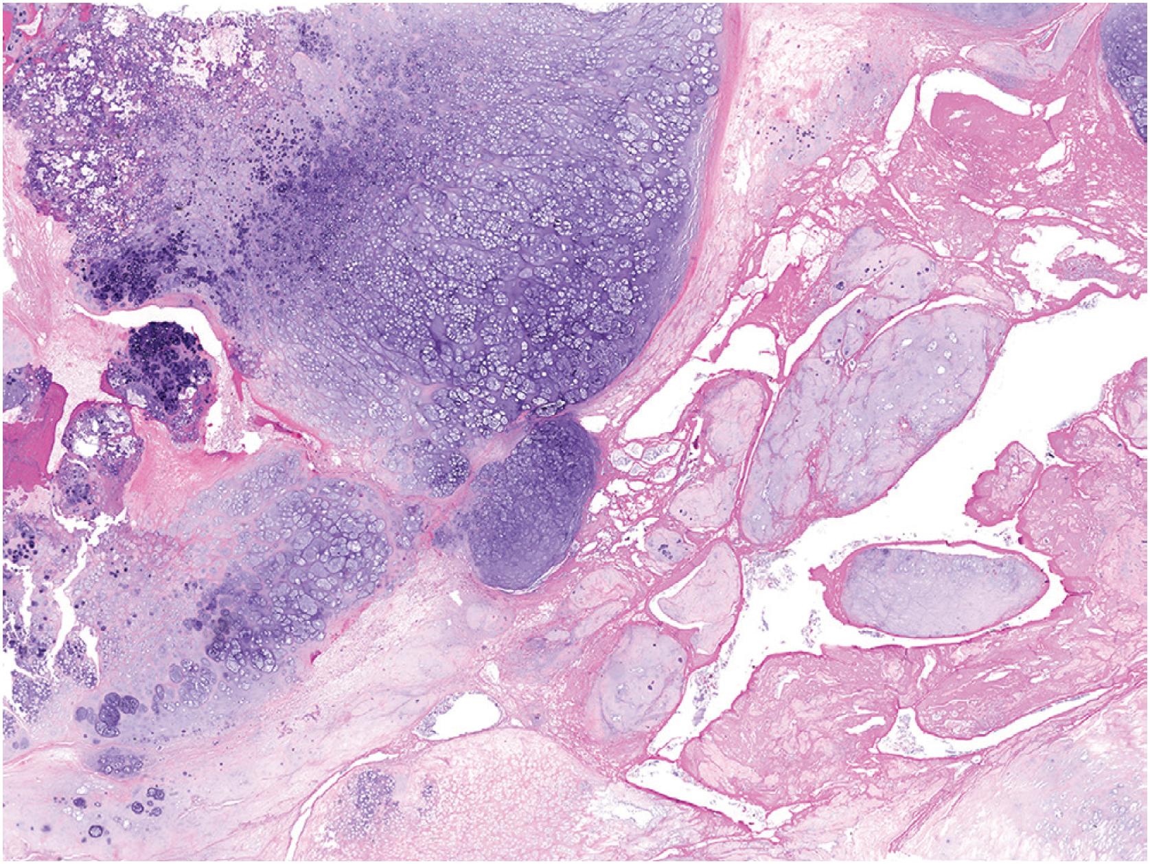 Fig. 17.18, Rarely, chondrosarcoma develops as a form of biologic progression in an osteochondroma (secondary peripheral chondrosarcoma). The diagnosis can be suggested by multinodular growth, cystic change, disorganization, and increased cellularity.