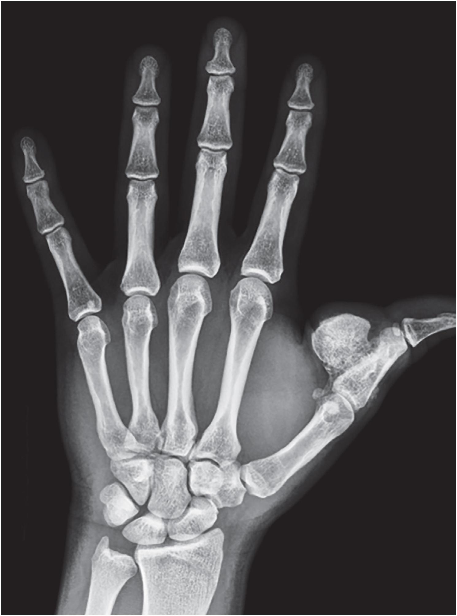 Fig. 17.19, Plain radiograph of the hand shows bizarre parosteal osteochondromatous proliferation (BPOP) as a well-delineated, mushroom-shaped, partially mineralized, exophytic mass arising from the surface of the first proximal phalanx. The underlying cortex is intact, and there is an associated soft tissue swelling.